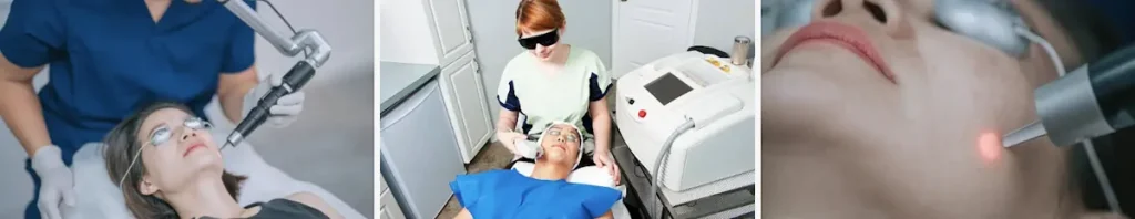 akne efter laserbehandling