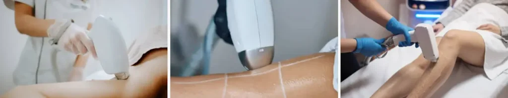alexandritlaser