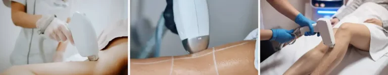 alexandritlaser