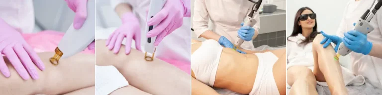 Alexandritlaser för hårborttagning och pigmentfläckar