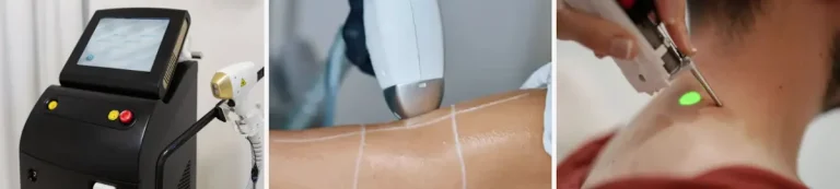 alla hudtyper behandlas med laserhårborttagning