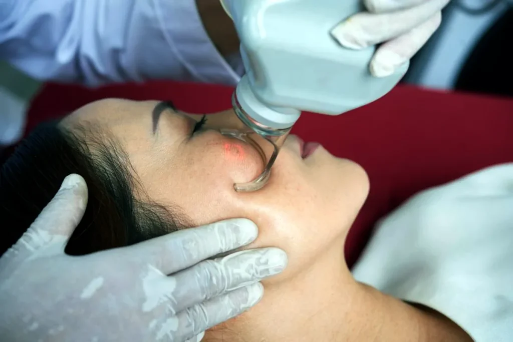 användning av erbiumlaser för hudföryngring