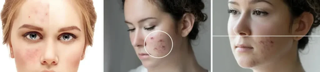 användning av laser för att behandla akneärr