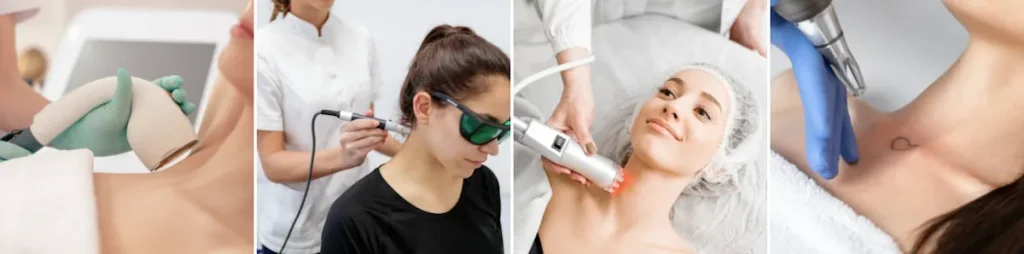 Användning av laser för att behandla dekolletage