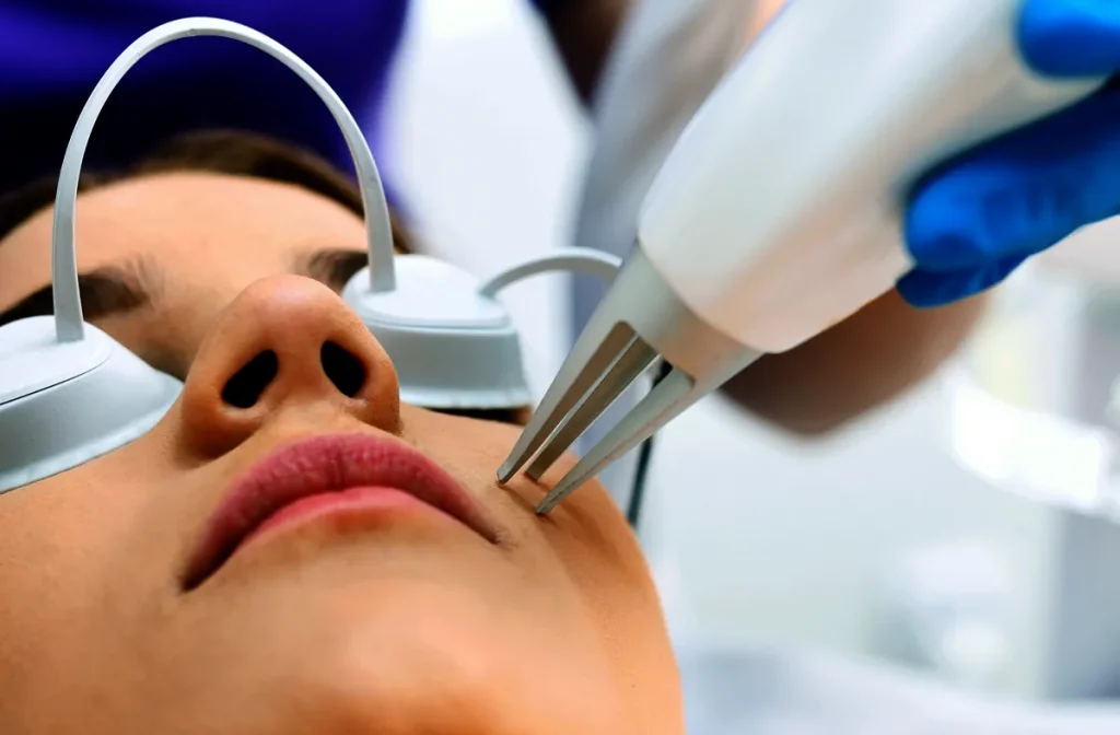 användning av laser för att förbättra akne