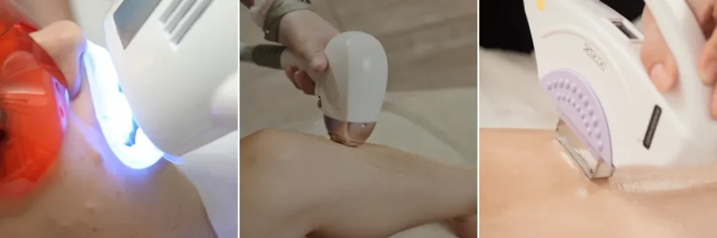 Användning av laser för att förbättra hudens fasthet