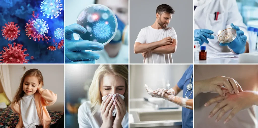 Användning av laser för att förbättra hudens utseende efter bakterieinfektioner