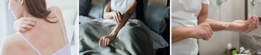 Användning av laser för att förbättra hudens utseende efter kemiska exponeringar