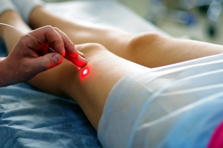 är laserbehandlingar för åderbråck lämpliga för alla