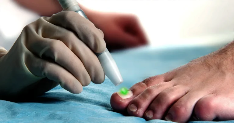 är laserbehandlingar för nagelsvamp smärtsamma