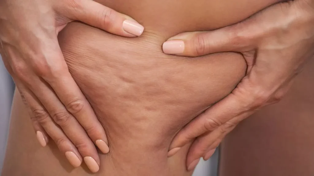 är resultaten från laserbehandlingar för celluliter permanenta
