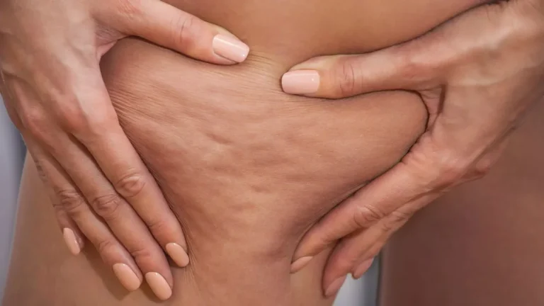är resultaten från laserbehandlingar för celluliter permanenta