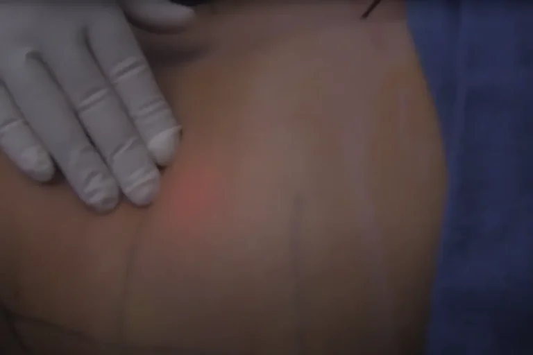 är resultaten från laserfettsugning permanenta