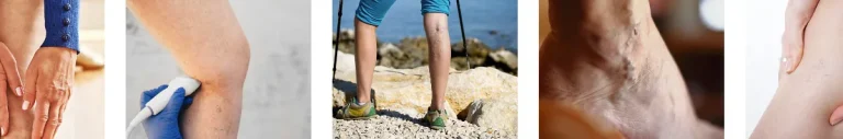 Återfall av åderbråck eller kärlproblem efter laserbehandling