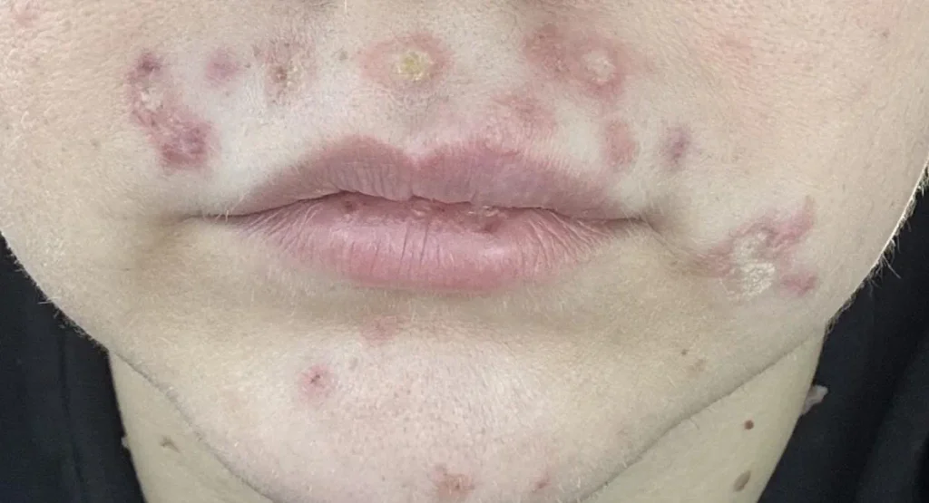 Återkommande eller långvarig infektion efter laserbehandling