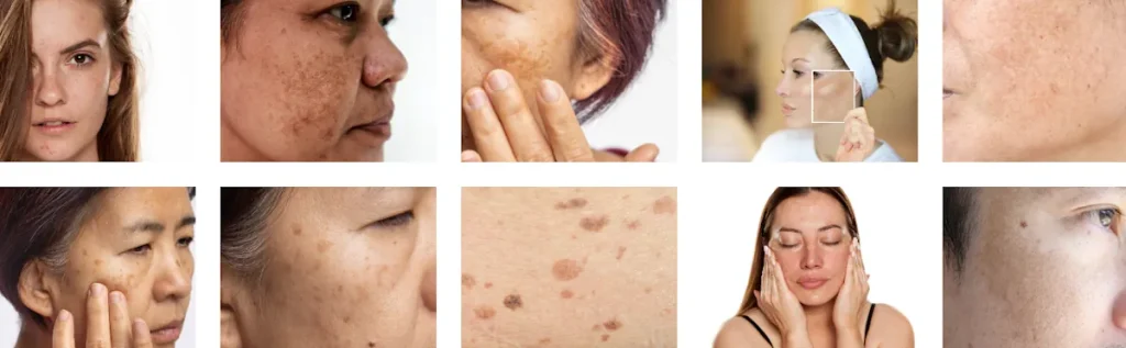 Återkomst av behandlat tillstånd efter laserbehandling