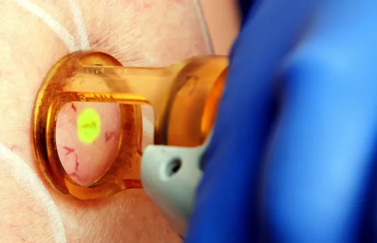 behandlar åderbråck med laser