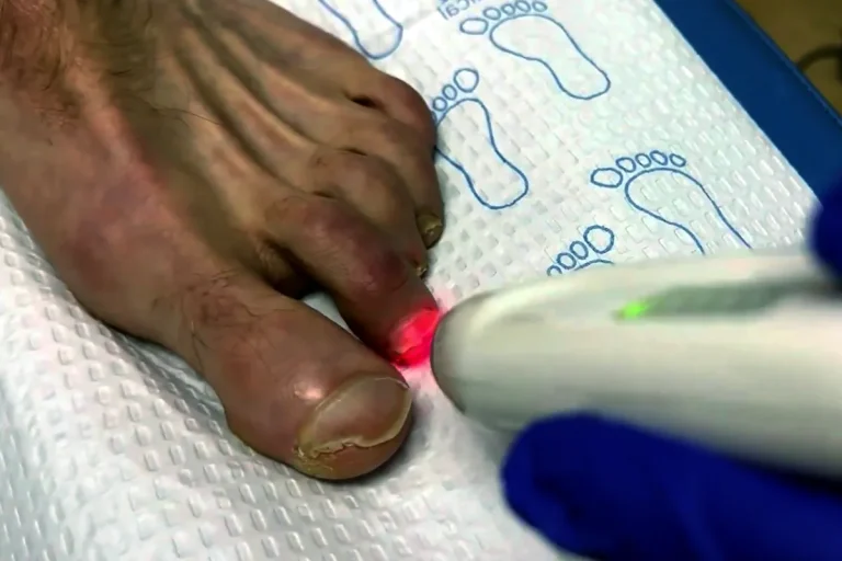 behandlar nagelsvamp med laser