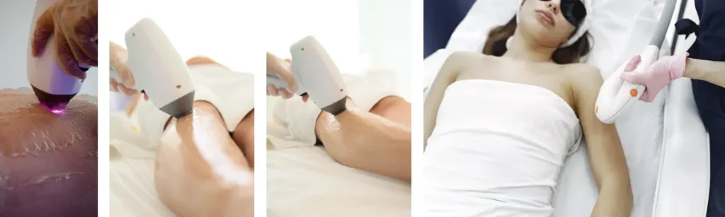 Behandlingsområdets asymmetri efter laserbehandling