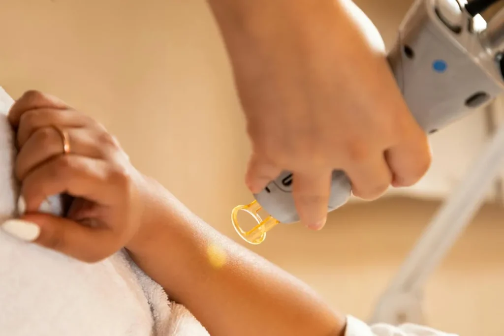 Blåmärken efter laserbehandling