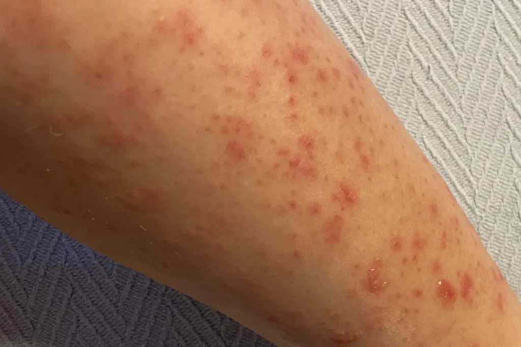 Blåsbildning efter laserbehandling