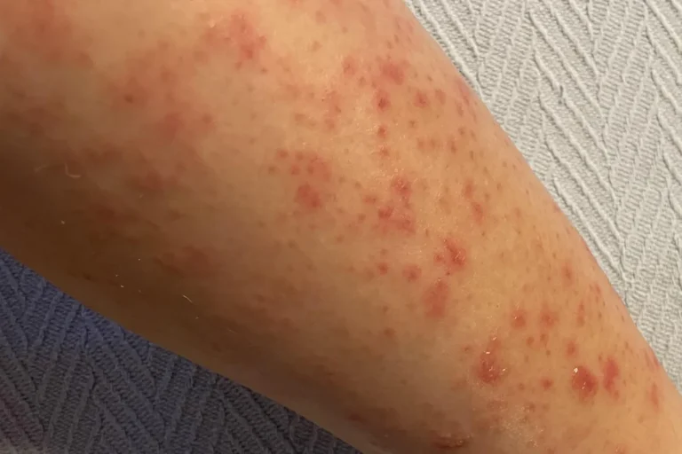Blåsbildning efter laserbehandling