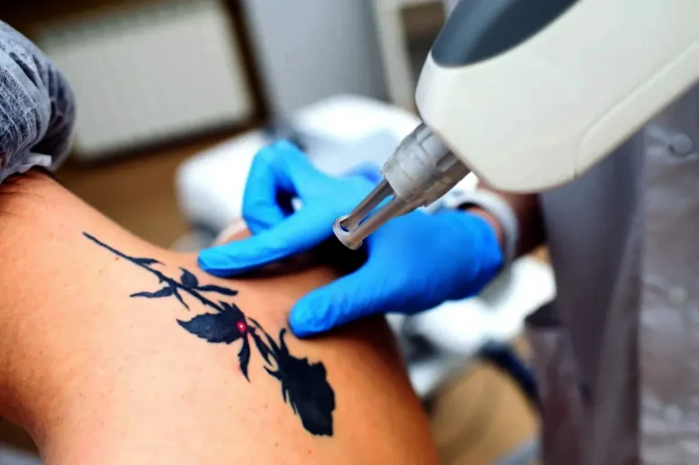 borttagning av tatuering med laser