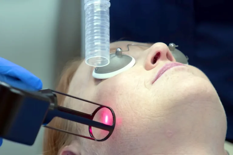 co2 laserbehandling