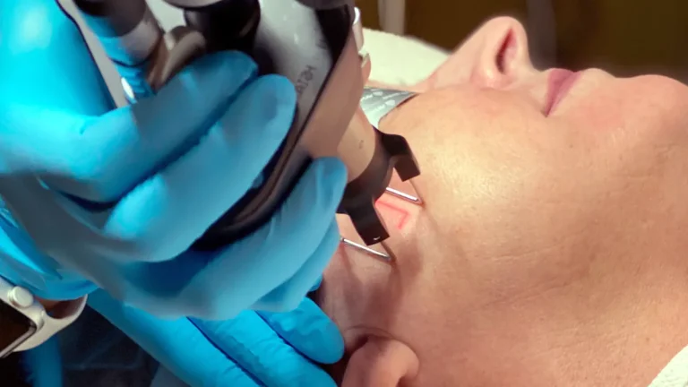 co2 laserresurfacing