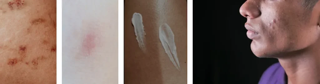 Eksem eller dermatit på behandlat område efter laserbehandling