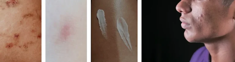 Eksem eller dermatit på behandlat område efter laserbehandling