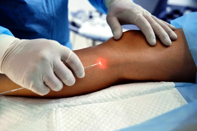 endovenös laserbehandling