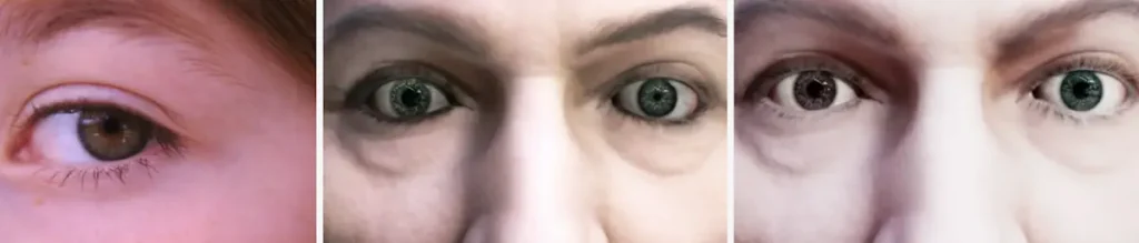 Förändring i pupillstorlek eller form efter laserbehandling