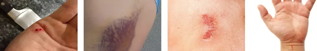 Fördelar med laser för att förbättra hudens utseende efter fysiska skador