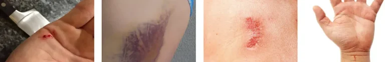 Fördelar med laser för att förbättra hudens utseende efter fysiska skador