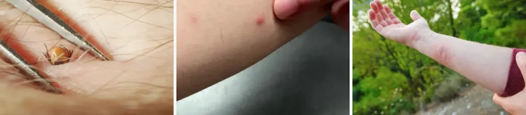 Fördelar med laser för att förbättra hudens utseende efter parasitinfektioner