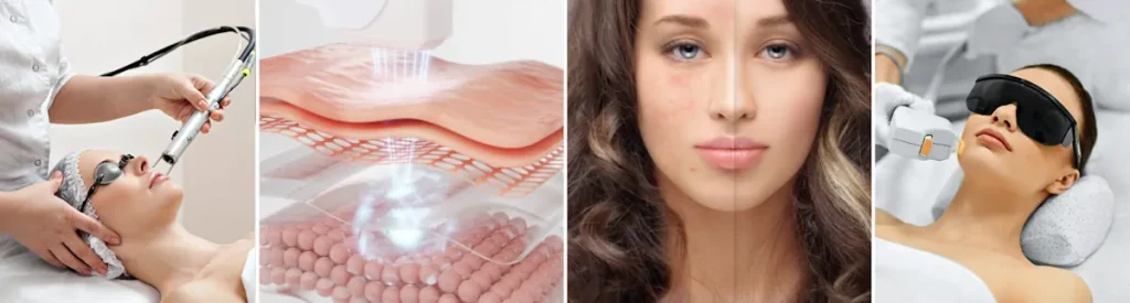 Fördelar med laser för att förbättra hudens utseende efter regenerativ medicin