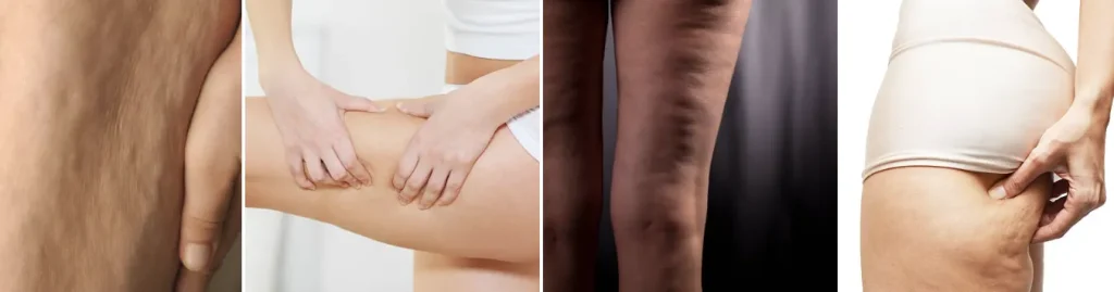 fördelar med laser för cellulitreduktion