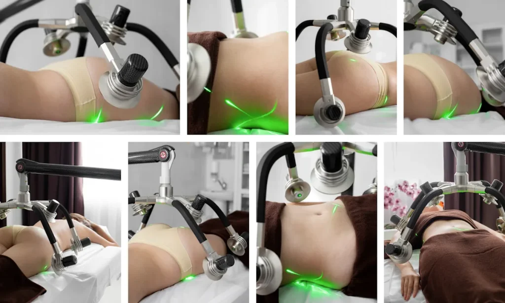 Fördelar med laserfettsugning