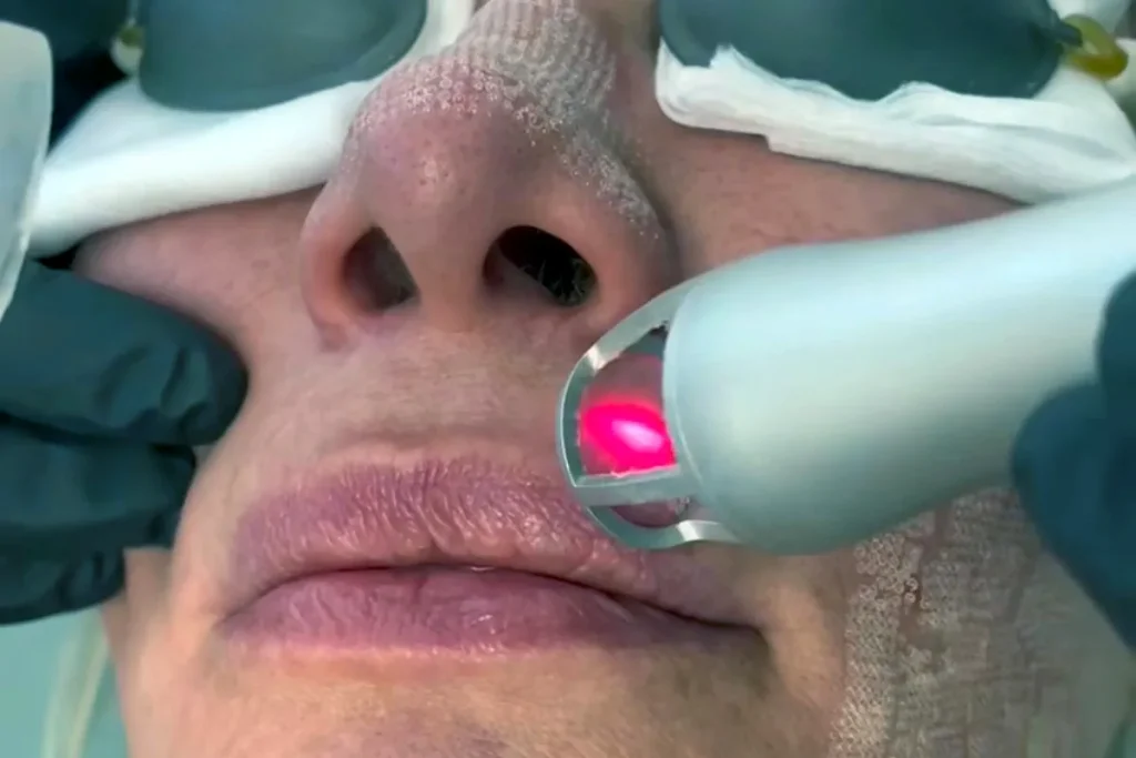 fördelarna med co2 laserresurfacing