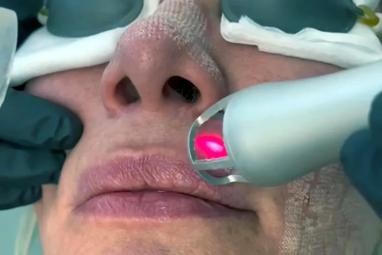 fördelarna med co2 laserresurfacing