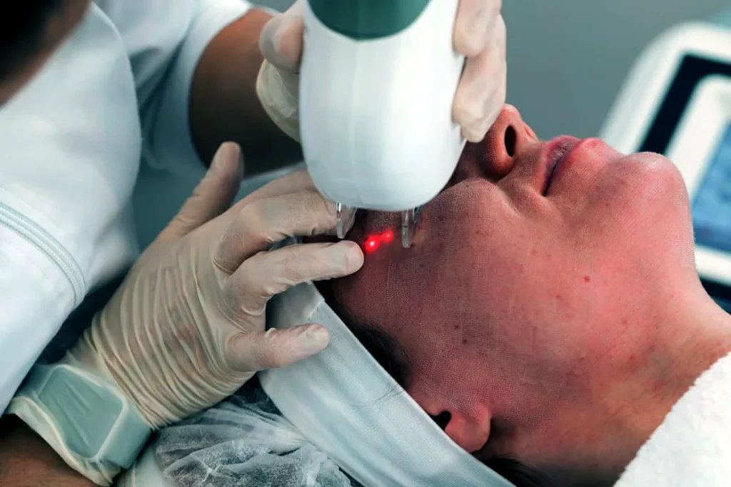 fractional co2 laser behandling