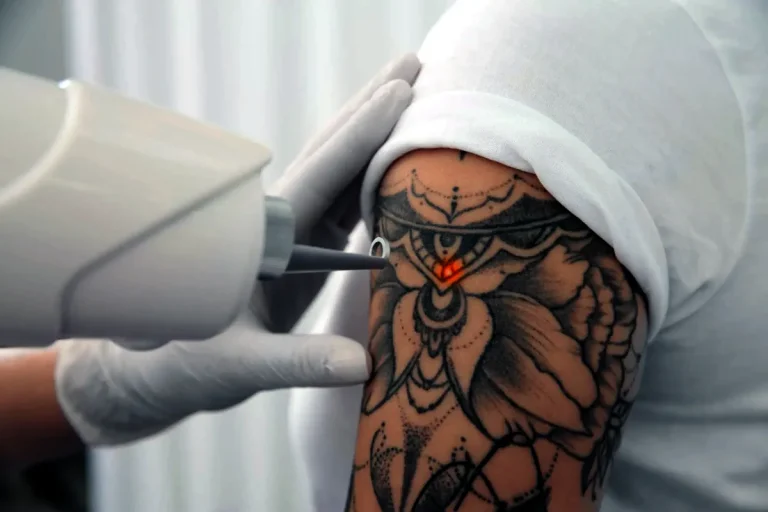 fungerar laserborttagning av tatueringar