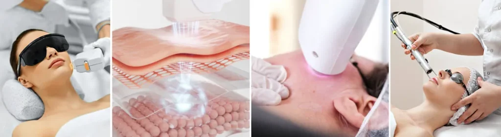 Hudatrofi efter laserbehandling