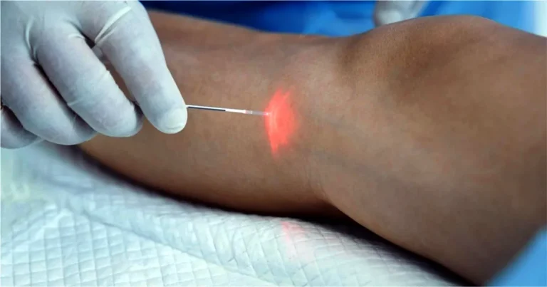 hur fungerar laserbehandling för åderbråck