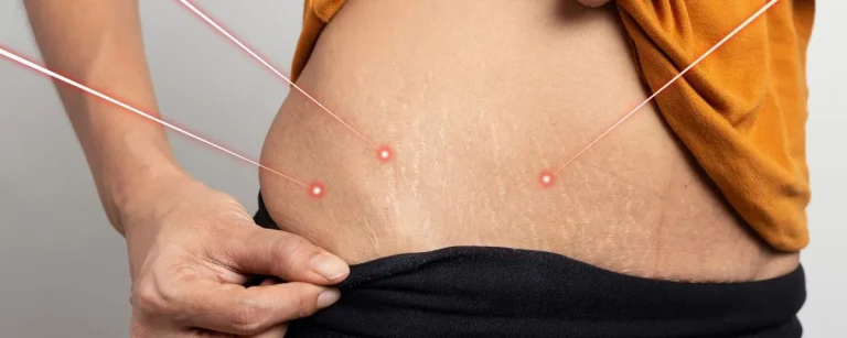 hur fungerar laserbehandlingar för bristningar