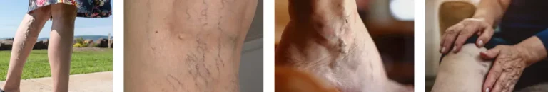 hur fungerar laserbehandlingar för kärlproblem