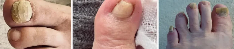 hur fungerar laserbehandlingar för nagelsvamp