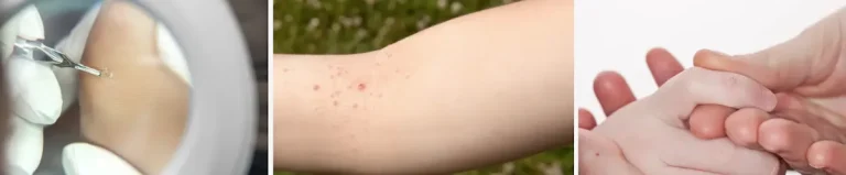 hur fungerar laserbehandlingar för vårtor