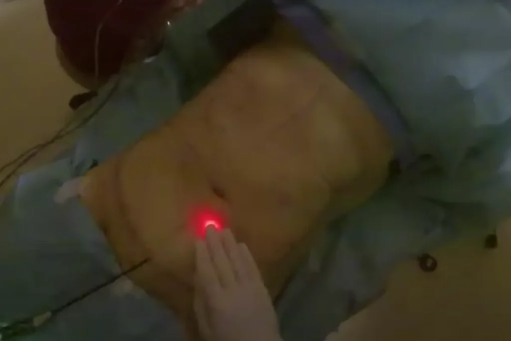 hur fungerar laserfettsugning